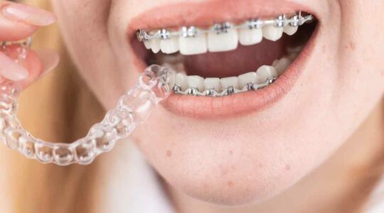 l’orthodontie adulte